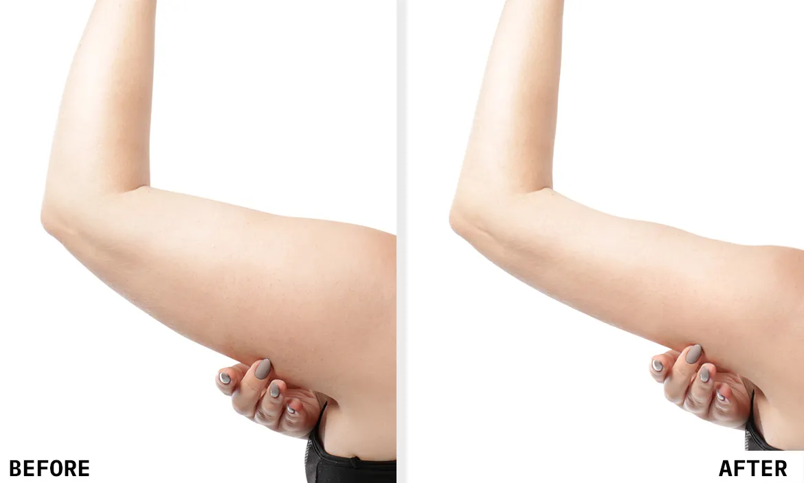 Before and After Results 4